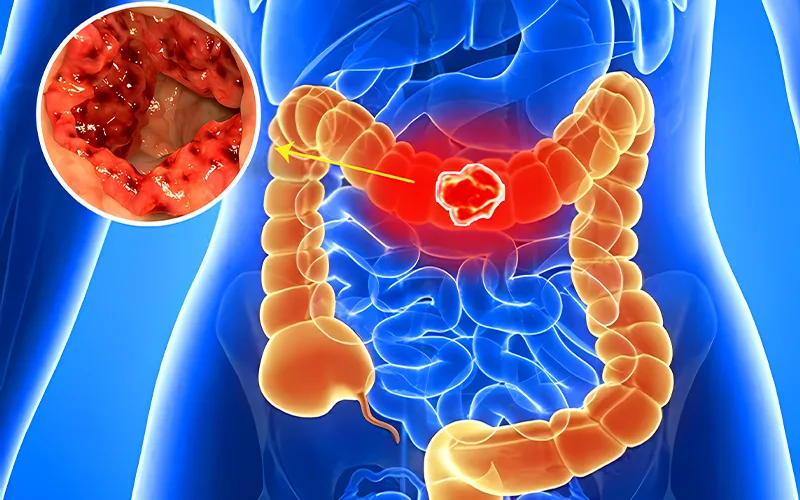 Tại Sao Cần Phát Hiện Sớm?