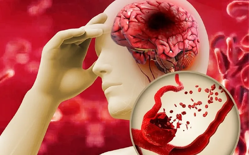 Nguy cơ gây đột quỵ từ sức khỏe tổng thể