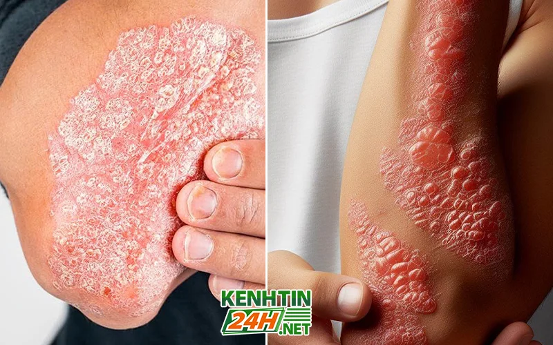 Tình trạng vảy nến trong cộng đồng