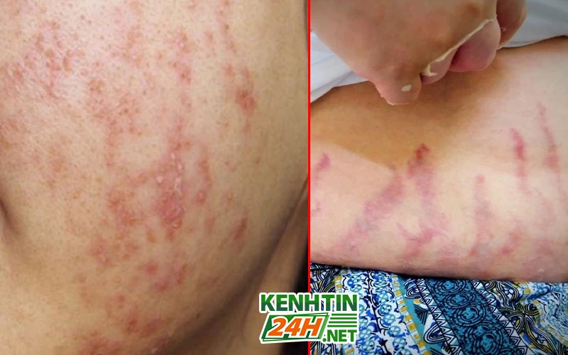 Triệu chứng và tác hại của việc lạm dụng corticoid